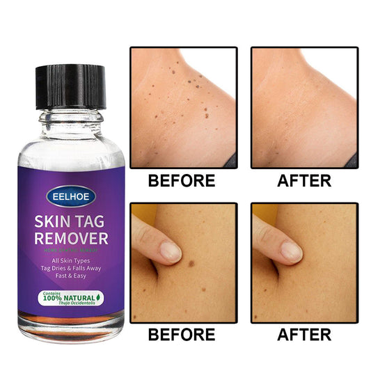 Eelhoe Skin Tag Remover - Fast & Painless Skin Tag Treatment - 30ml