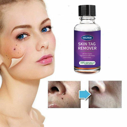 Eelhoe Skin Tag Remover - Fast & Painless Skin Tag Treatment - 30ml