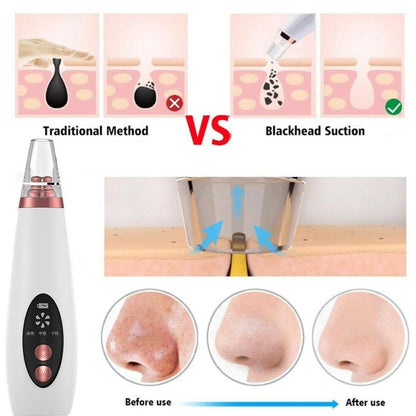 Microcrystalline Blackhead Remover - Deep Pore Cleaner & Exfoliator