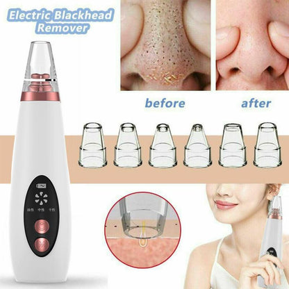 Microcrystalline Blackhead Remover - Deep Pore Cleaner & Exfoliator